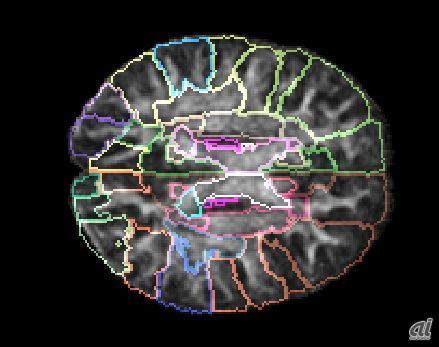 図1:脳のMRI画像からの解剖学的見地に立ったラベリング